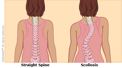 A comparison of a normal spine, which is straight, and an "ess" shaped curve in a spine with scoliosis.
