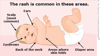 Where babies can get seborrheic dermatitis