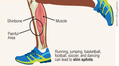 Diagram labels the shinbone, muscle, and painful area on the shin. Running, jumping, basketball, football, soccer, and dancing can lead to shinsplints.