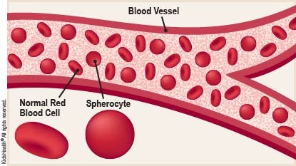 Diagram showing a normal red blood cell shaped like a disc. The diagram also shows a red blood cell in someone who has hereditary spherocytosis. This blood cell is shaped like a sphere