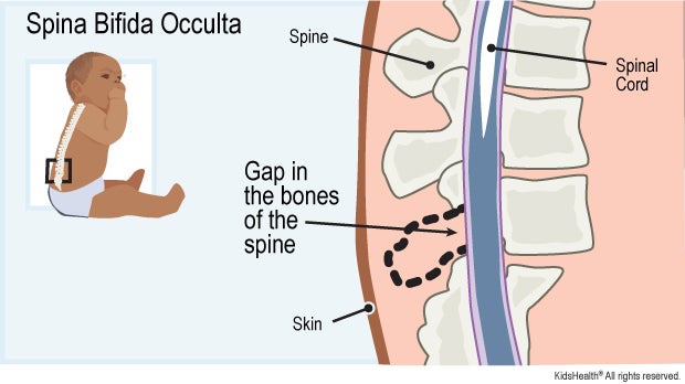 Spina bifida occulta diagram labels spinal cord, spine, skin, gap in the bones of the spine.