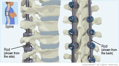 Illustration: spinal fusion