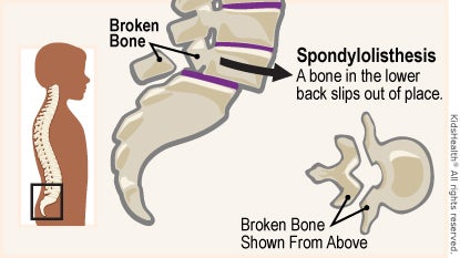 A broken bone in the lower back slips out of place