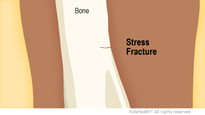 Illustration: Stress Fracture