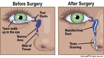 Diagram showing location of the tear duct, or nasolacrimal duct. The diagram shows that when the duct is blocked by a web of tissue, tears can’t drain and they build up in the eye. When the blockage is removed by surgery, the tears can drain.