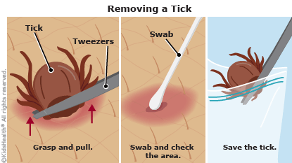Art shows how to remove a tick from skin, as explained in the article