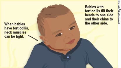 Picture shows how a baby with tight neck muscles from torticollis turns the head to one side