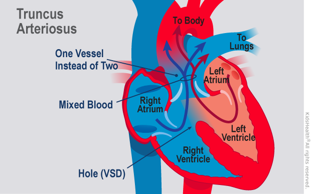 truncus arteriosus illustration