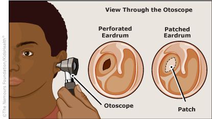 View of a perforated eardrum and a patched eardrum after a tympanoplasty.