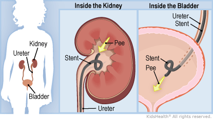 Illustration: ureteral stent
