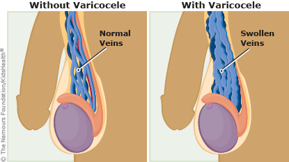with and without varicocele illustration