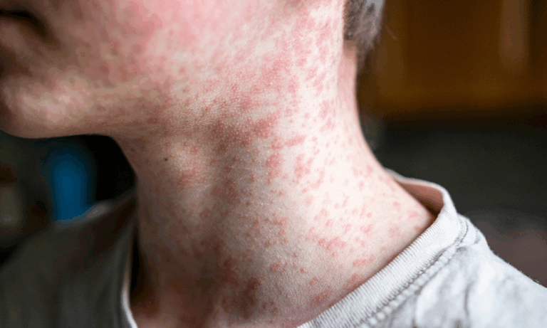 Kentucky measles outbreak: What families in Kentucky and Southern Indiana need to know