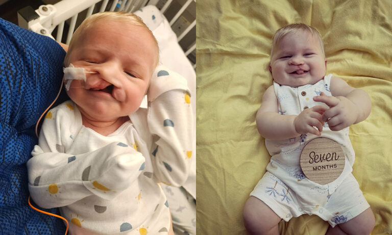 Owensboro infant unable to eat with cleft palate thrives after specialized care at Norton Children’s
