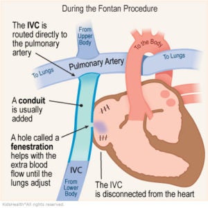 An illustration shows changes to the IVC during the Fontan procedure