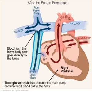 An illustration shows the right ventricle after the Fontan procedure