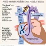 Glenn Procedure | Norton Children's Louisville, Ky.