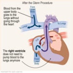 Glenn Procedure | Norton Children's Louisville, Ky.