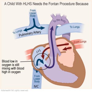 Fontan Procedure | Norton Children's Louisville, Ky.