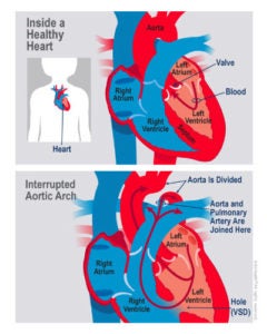 interrupted aortic arch type