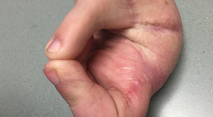 Toe-hand thumb replacement