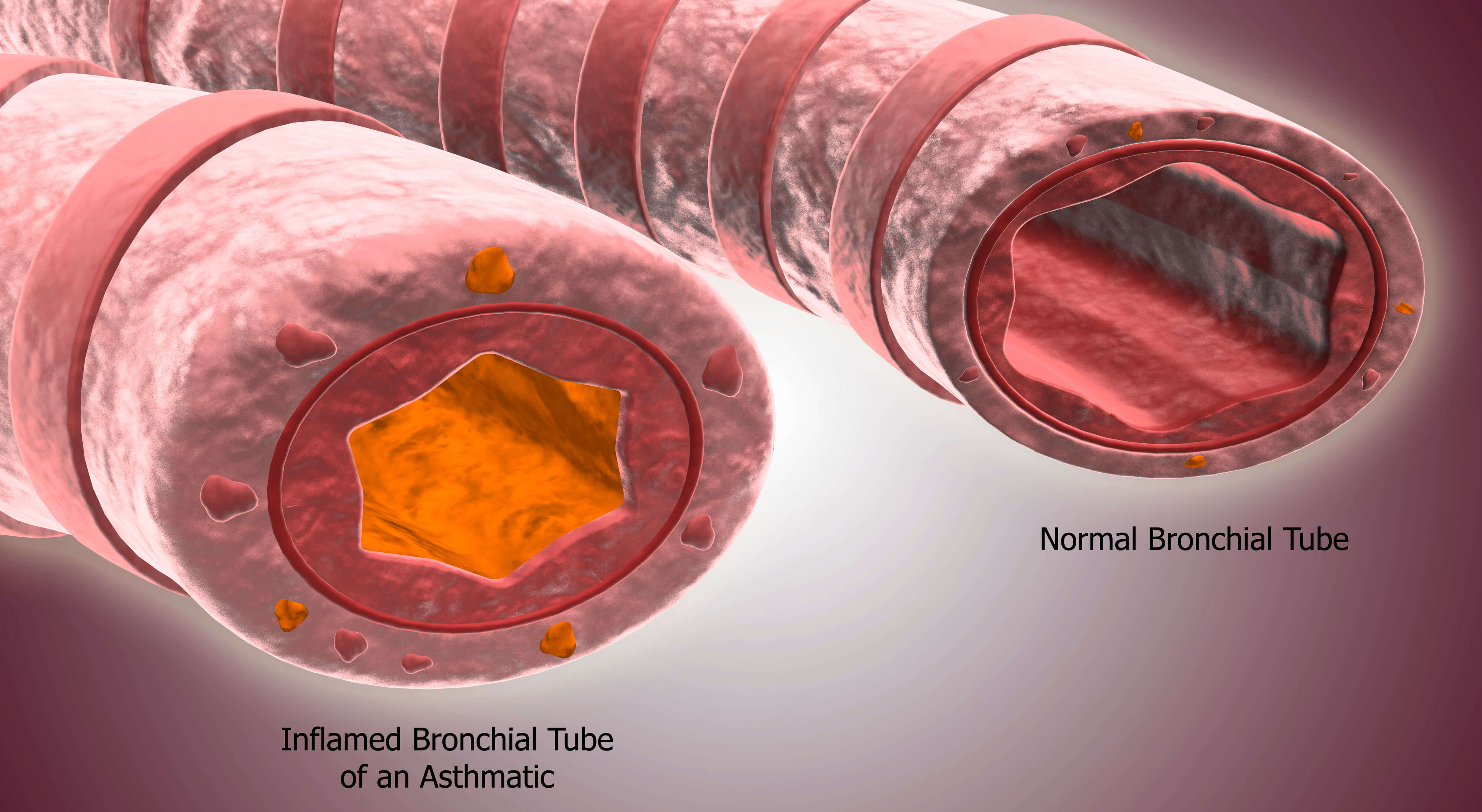 asthma bronchial tubes