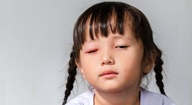 How Do Toddlers Get Pink Eye?