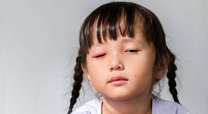 how-long-is-pink-eye-contagious-norton-children-s-louisville-ky