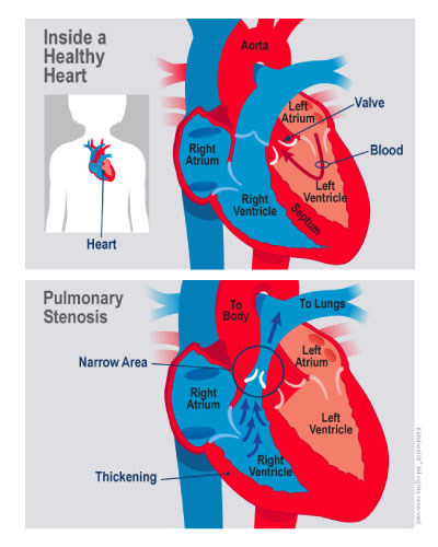 A diagram shows congenital pulmonary valve stenosis in comparison to a healthy child's heart